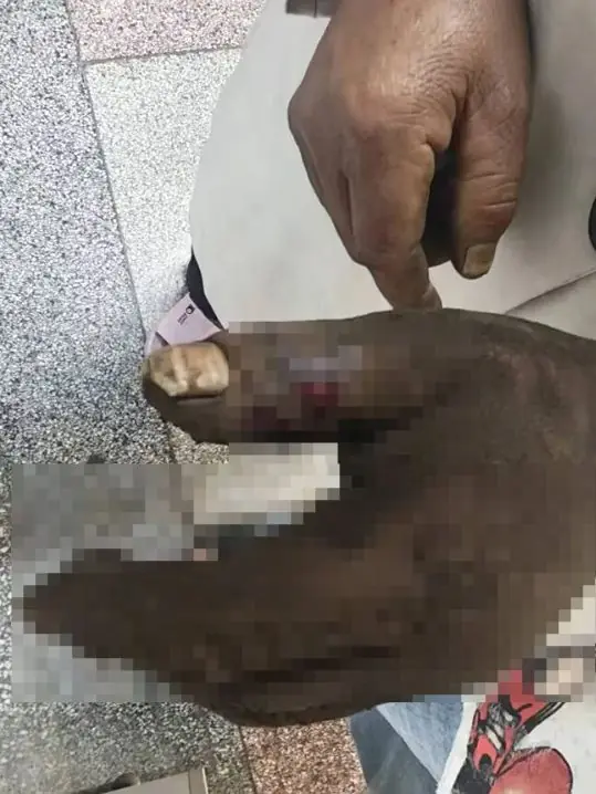 一大爷被蛇咬伤,老伴情急之下用嘴吸蛇毒,结果双双紧急送医抢救